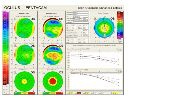 高階檢查設備～Pentacam 角膜多功能攝影分析儀