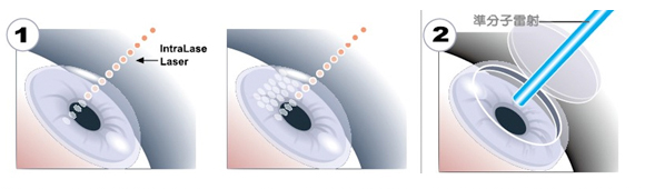 IntraLase飛秒雷射說明