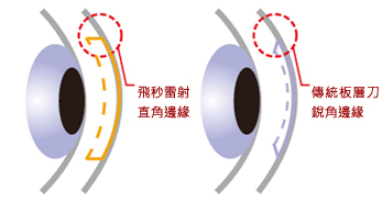 第五代IntraLase飛秒雷射(iFS 150)特點