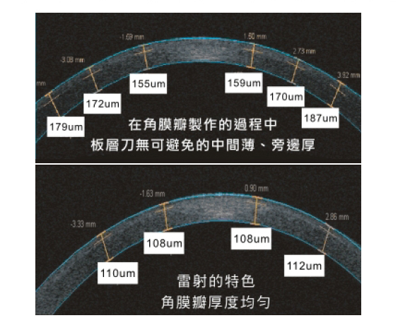 更薄更精準的角膜瓣　讓近視手術更安全