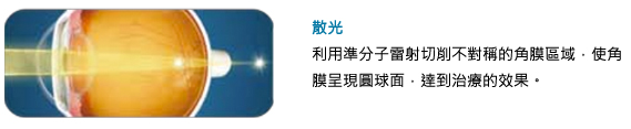 散光:利用準分子雷射切削不對稱的角膜區域，使角膜呈現圓球面，達到治療的效果。